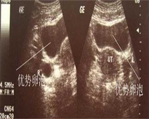 子宫内膜容受性差